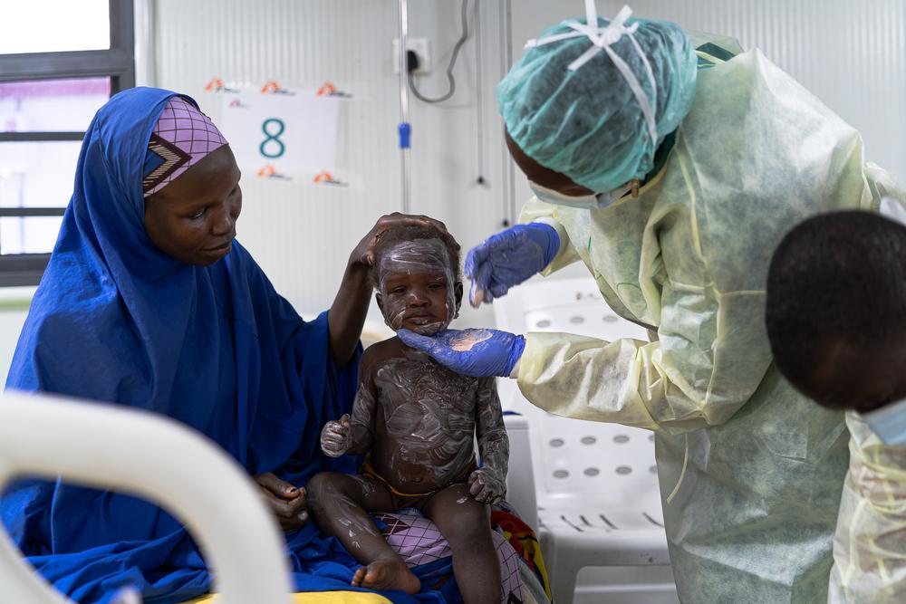 Un jeune patient atteint de rougeole est traité avec une pommade au zinc à Maiduguri, au Nigeria © Georg Gassauer