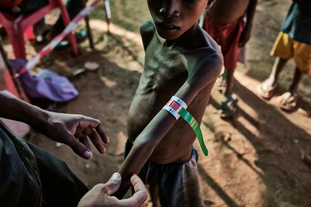 Les équipes MSF procèdent à des évaluations de la malnutrition lors d&#039;une clinique mobile installée dans le village de Ranobe.District d&#039;Amboasary. Madagascar. Avril 2021. 