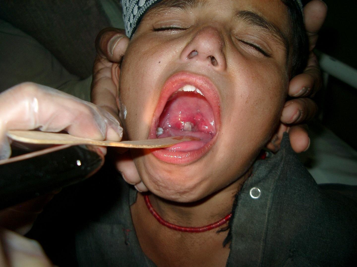 Un patient atteint de diphtérie en Afghanistan. 